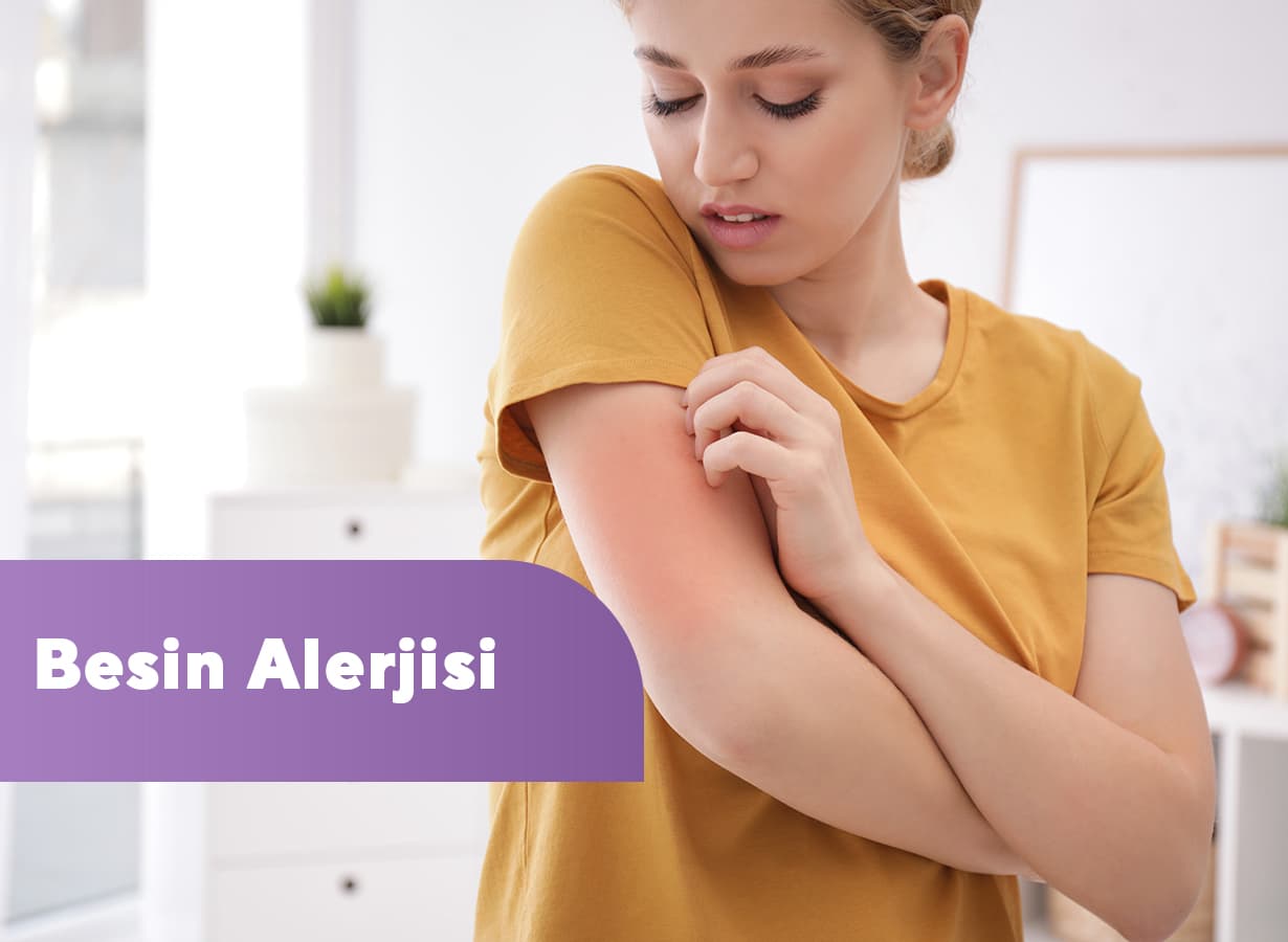 Besin Alerjisi Nedir? En Sık Alerji Yapan Besinler Nelerdir?