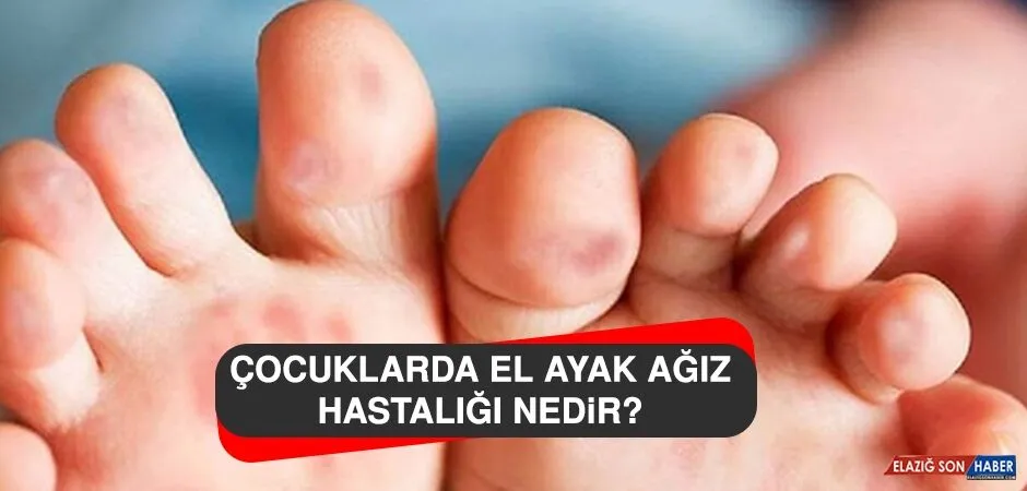Çocuklarda El Ayak Ağız Hastalığı: Nedir? Tedavi Yöntemleri